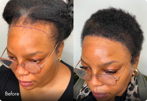 Before and after — FUE — frontal hairline restoration, 1,850 grafts